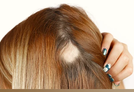 Alopecia areata